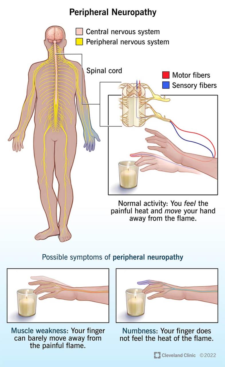 How Long Does It Take For Neuropathy To Vanish 3191