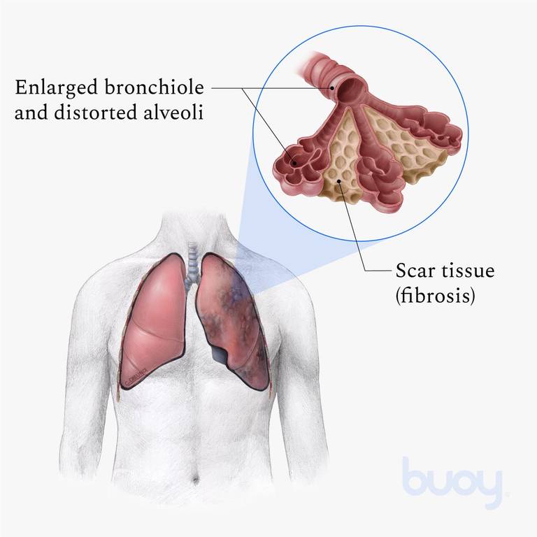 Does Pulmonary Fibrosis Cause Chest Pain